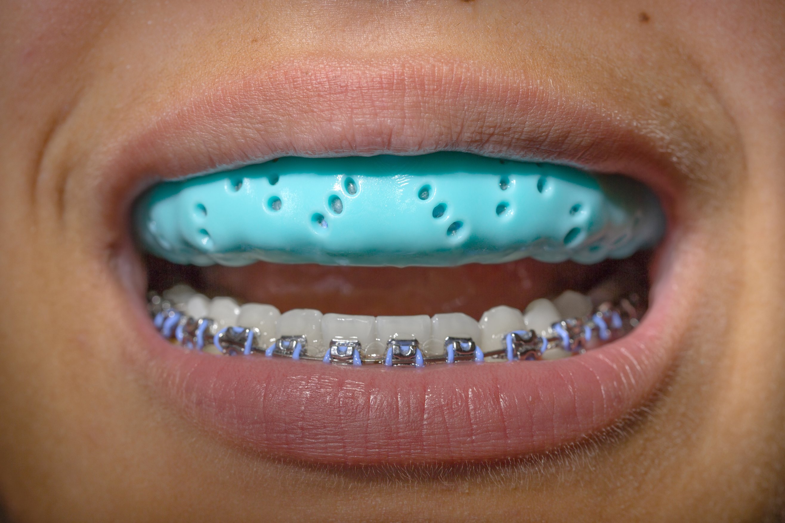 BRACES AND MOUTHGUARDS. IT'S A BIG DEAL.