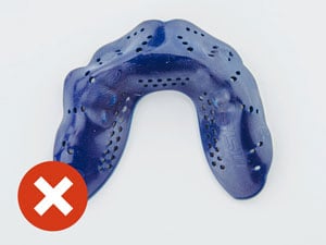 Mouthguard from overhead molded poorly.